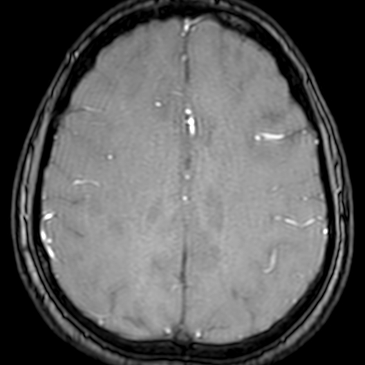 Cerebral arteriovenous malformation at posterior body of corpus callosum (Radiopaedia 74111-84925 Axial MRA 157).jpg