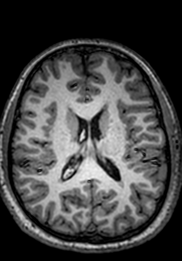 Cerebral arteriovenous malformation at posterior body of corpus callosum (Radiopaedia 74111-84925 Axial T1 117).jpg