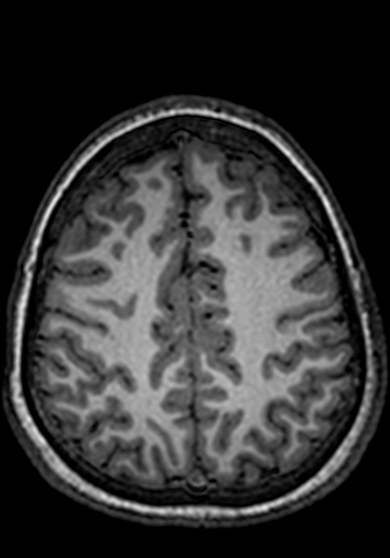 Cerebral arteriovenous malformation at posterior body of corpus callosum (Radiopaedia 74111-84925 Axial T1 66).jpg