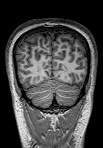 File:Cerebral arteriovenous malformation at posterior body of corpus callosum (Radiopaedia 74111-84925 Coronal T1 297).jpg