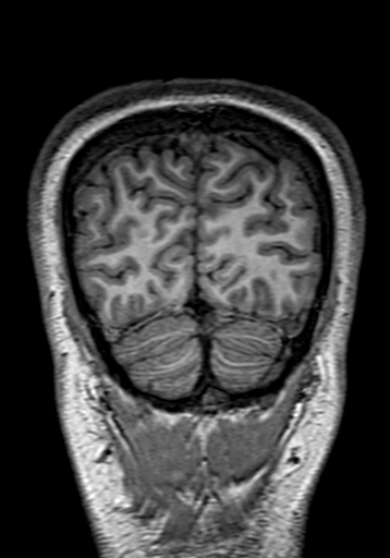 Cerebral arteriovenous malformation at posterior body of corpus callosum (Radiopaedia 74111-84925 Coronal T1 310).jpg