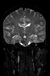 Cerebral arteriovenous malformation at posterior body of corpus callosum (Radiopaedia 74111-84925 Coronal T2 93).jpg