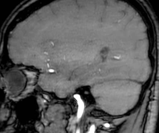 Cerebral arteriovenous malformation at posterior body of corpus callosum (Radiopaedia 74111-84925 J 104).jpg