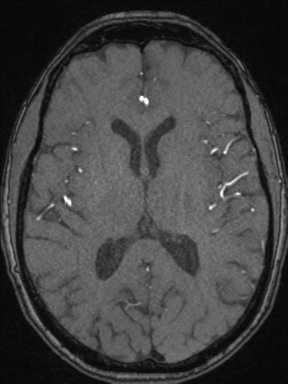 Cerebral arteriovenous malformation with hemorrhage (Radiopaedia 34422-35737 Axial MRA 45).png
