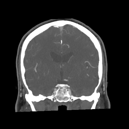 Cerebral arteriovenous malformation with lobar hemorrhage (Radiopaedia 35598-57216 C 45).jpg