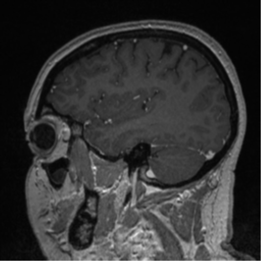 Cerebral cavernoma and development venous anomaly (Radiopaedia 37603-39482 Sagittal T1 C+ 70).png