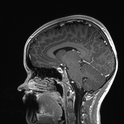 File:Cerebral cavernous venous malformation (Radiopaedia 70008-80021 Sagittal T1 C+ 32).jpg