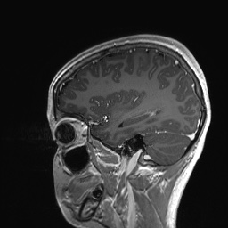 Cerebral cavernous venous malformation (Radiopaedia 70008-80021 Sagittal T1 C+ 52).jpg