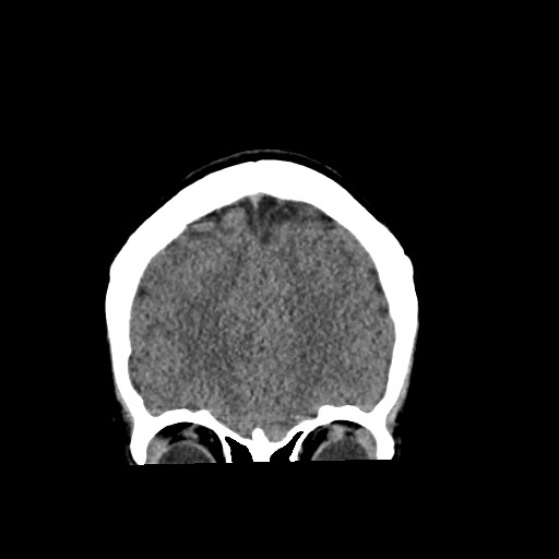 Cerebral cavernous venous malformation (Radiopaedia 70008-80022 non-contrast 15).jpg
