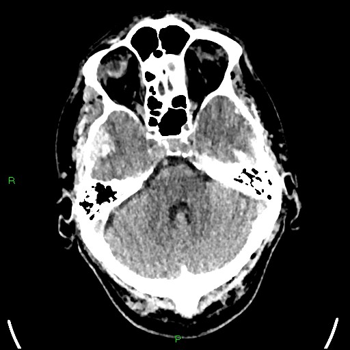 File:Cerebral contusions (Radiopaedia 33868-35039 Axial non-contrast 56).jpg