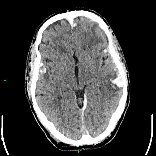 Cerebral contusions (Radiopaedia 33868-35039 Axial non-contrast 94).jpg