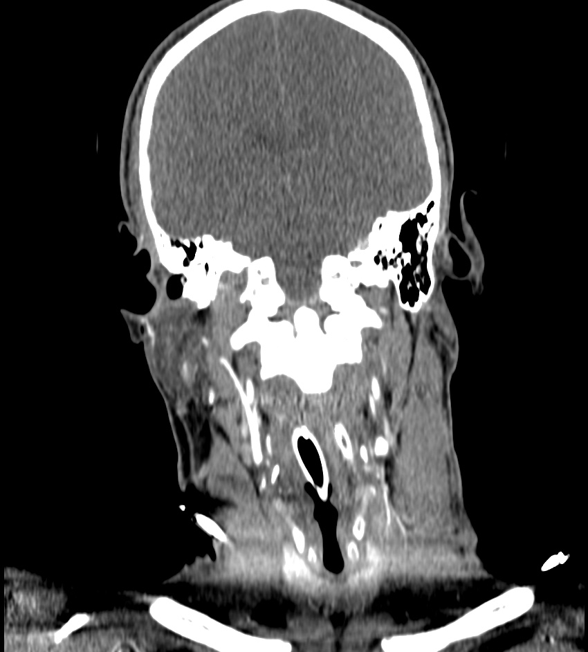 Cerebral edema in an overdose patient (Radiopaedia 72005-82539 B 78).jpg