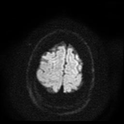 Cerebral embolic infarcts (embolic shower) (Radiopaedia 49837-55108 Axial DWI 54).jpg