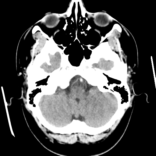 Cerebral hemorrhage secondary to arteriovenous malformation (Radiopaedia 33497-34561 B 12).png
