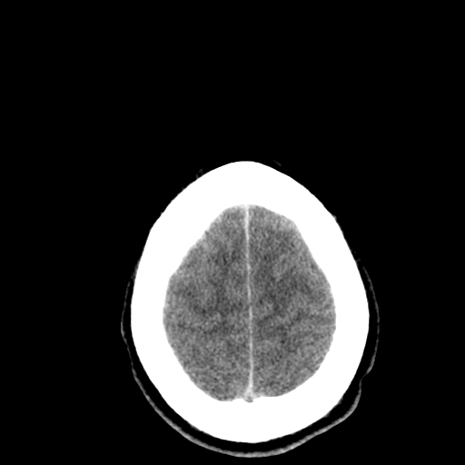 File:Cerebral hemorrhagic contusions- temporal evolution (Radiopaedia 40224-42753 Axial non-contrast 29).png
