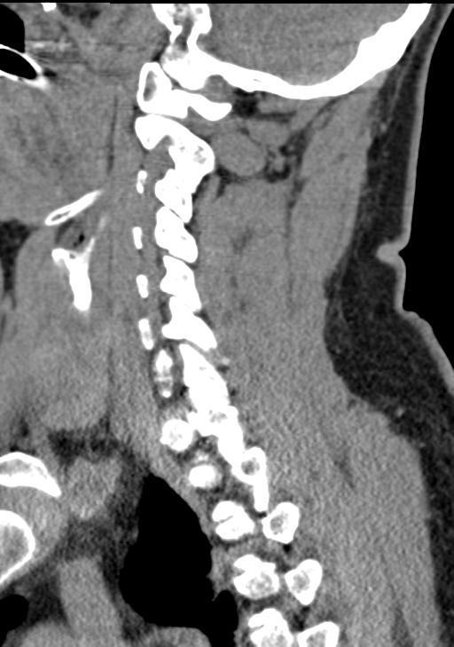 Cerebral hemorrhagic contusions and cervical spine fractures (Radiopaedia 32865-33841 G 70).jpg