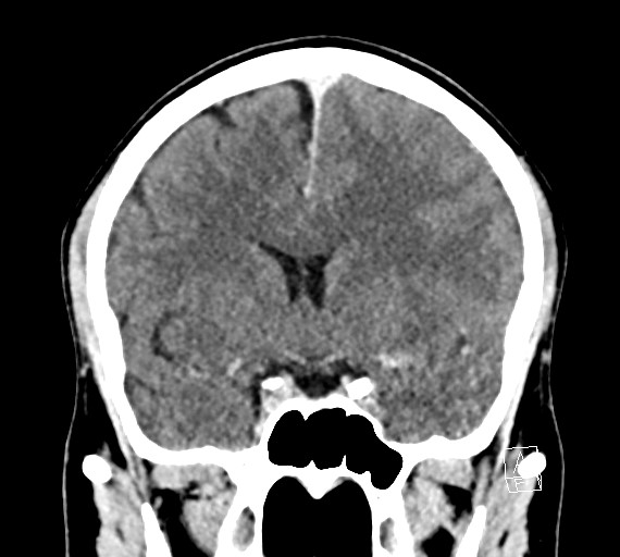 Cerebral metastases - testicular choriocarcinoma (Radiopaedia 84486-99855 D 26).jpg