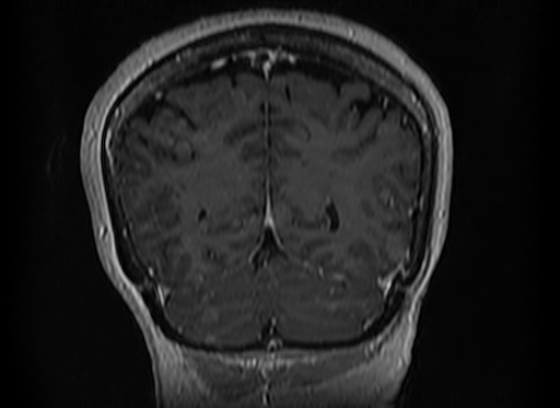 File:Cerebral metastases from lung cancer with amyloid angiopathy and cerebellopontine angle meningioma (Radiopaedia 74306-85191 Coronal T1 C+ 47).jpg