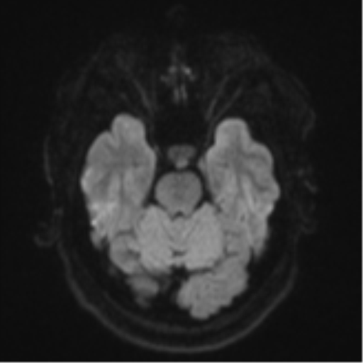 Cerebral metastases mimicking multifocal glioblastoma (Radiopaedia 50843-56353 Axial DWI 37).png