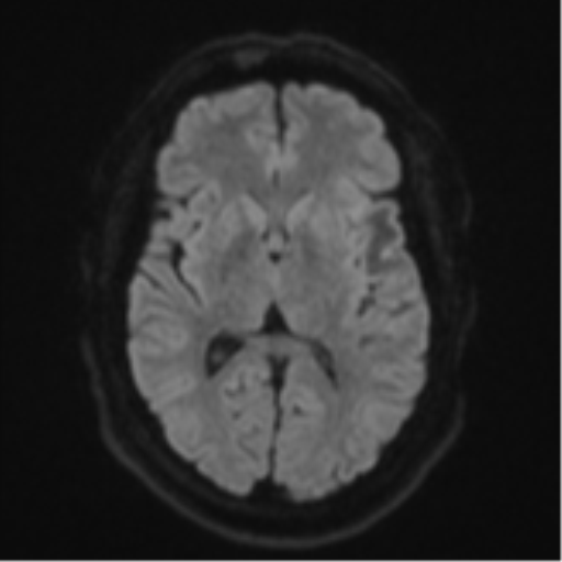 Cerebral metastases mimicking multifocal glioblastoma (Radiopaedia 50843-56353 Axial DWI 42).png