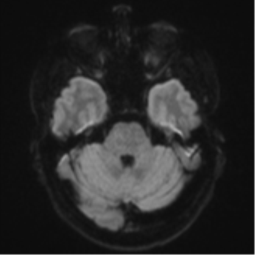 Cerebral metastasis - colorectal adenocarcinoma (Radiopaedia 50394-55765 Axial DWI 35).png