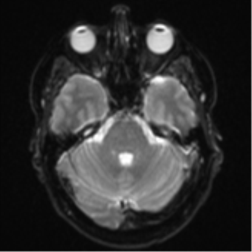 Cerebral metastasis - colorectal adenocarcinoma (Radiopaedia 50394-55765 Axial DWI 7).png