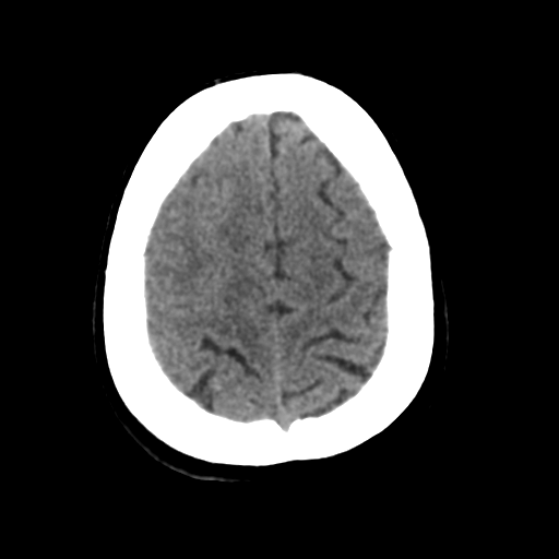 Cerebral metastasis to basal ganglia (Radiopaedia 81568-95412 Axial non-contrast 50).png