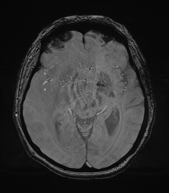 Cerebral metastasis to basal ganglia (Radiopaedia 81568-95413 Axial SWI magnitude 37).png