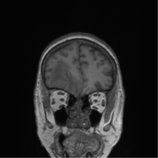 Cerebral metastasis to basal ganglia (Radiopaedia 81568-95413 Coronal T1 51).png