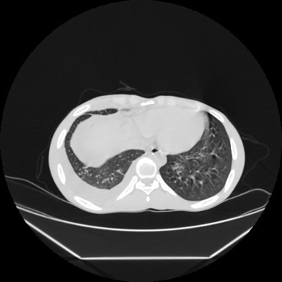 File:Cerebral tuberculoma (Radiopaedia 80829-94318 Axial lung window 144).jpg
