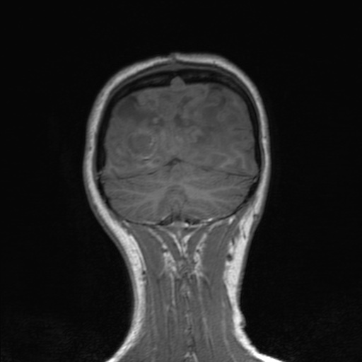 File:Cerebral tuberculosis with dural sinus invasion (Radiopaedia 60353-68090 Coronal T1 151).jpg