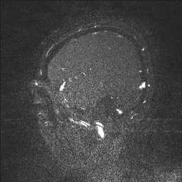 Cerebral tuberculosis with dural sinus invasion (Radiopaedia 60353-68090 Sagittal MRV 21).jpg