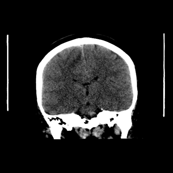 File:Cerebral venous hemorrhagic infarct from venous sinus thrombosis (Radiopaedia 55433-61879 Axial non-contrast 1).jpg