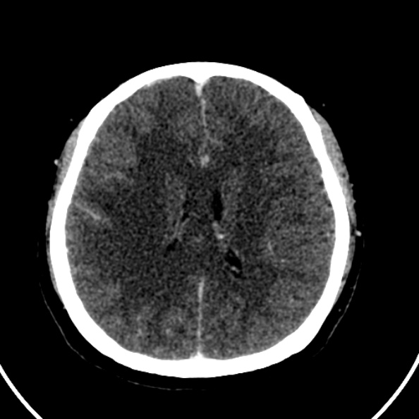 Cerebral venous hemorrhagic infarct from venous sinus thrombosis (Radiopaedia 55433-61883 Axial C+ delayed 62).jpg