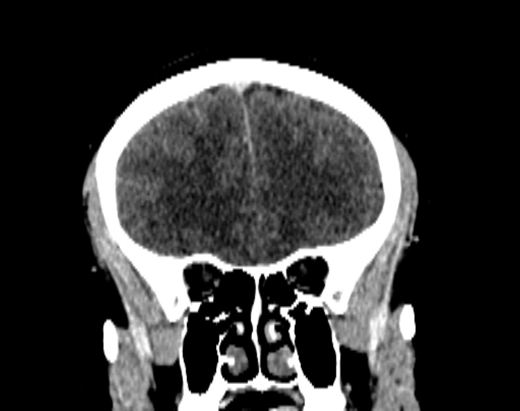 Cerebral venous hemorrhagic infarct from venous sinus thrombosis (Radiopaedia 55433-61883 Coronal C+ delayed 22).jpg
