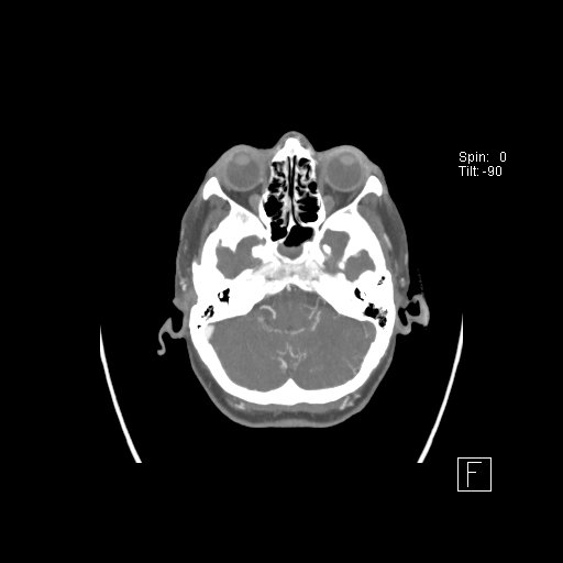 Cerebral venous infarction with hemorrhage (Radiopaedia 65343-74396 A 20).jpg