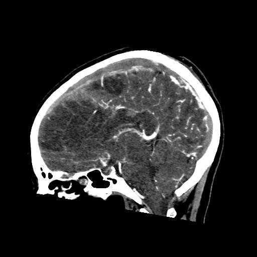 File:Cerebral venous throbmosis - hemorrhagic venous infarction (Radiopaedia 87318-103613 Sagittal CT venogram 22).jpg