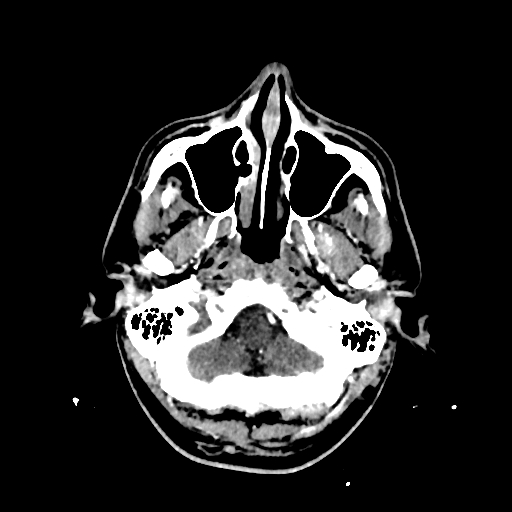 File:Cerebral venous thrombosis (CVT) (Radiopaedia 77524-89685 Axial with contrast 5).jpg