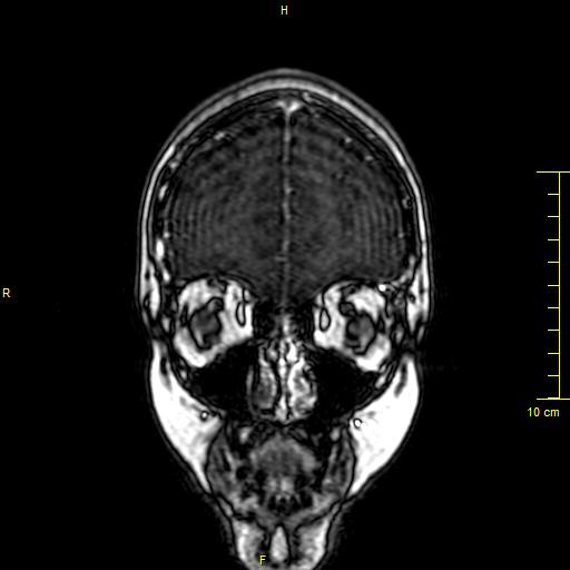 Cerebral venous thrombosis (Radiopaedia 23288-23351 MRV 1).JPG