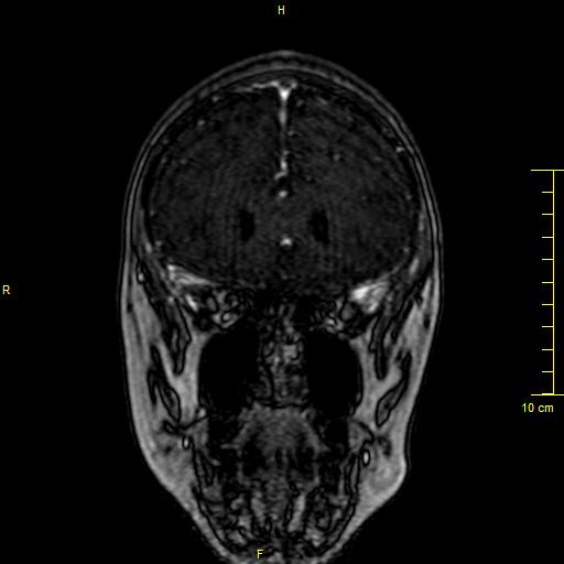 File:Cerebral venous thrombosis (Radiopaedia 23288-23351 MRV 22).JPG
