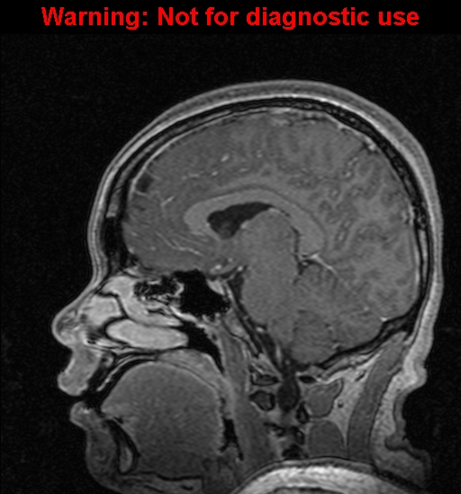 Cerebral venous thrombosis (Radiopaedia 37224-39208 Sagittal T1 C+ 71).jpg