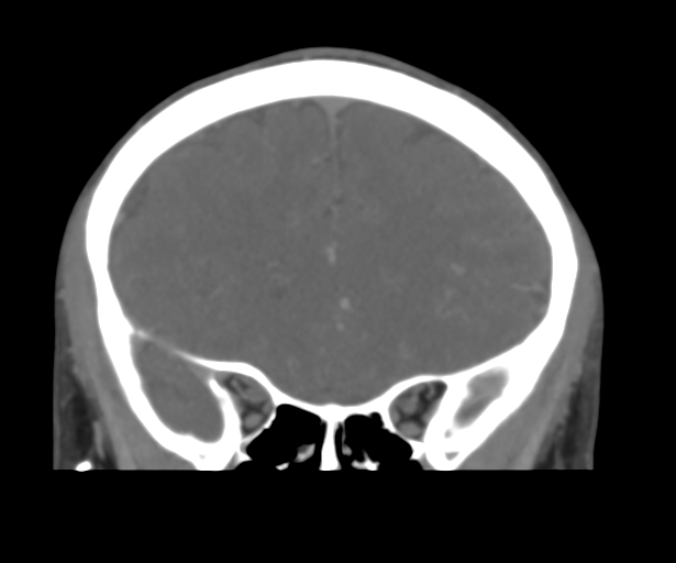 File:Cerebral venous thrombosis (Radiopaedia 38392-40467 Coronal CTA-Venogram 20).png