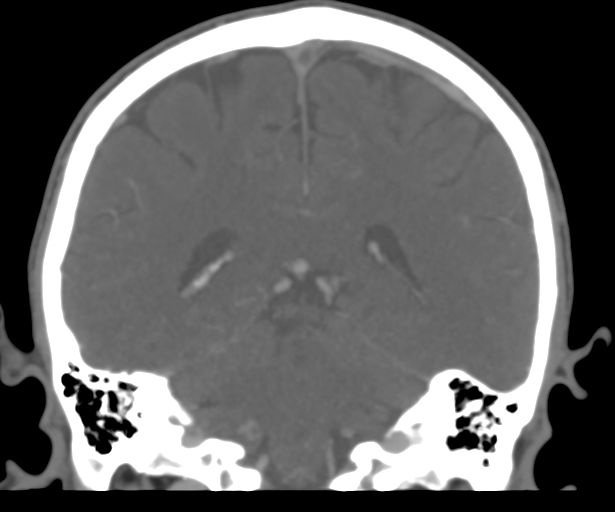 Cerebral venous thrombosis (Radiopaedia 38392-40467 Coronal CTA-Venogram 41).png