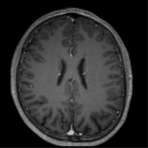 Cerebral venous thrombosis (Radiopaedia 38392-40469 Axial T1 C+ 51).png