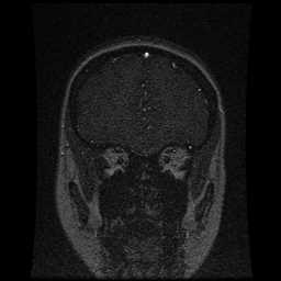 Cerebral venous thrombosis - ulcerative colitis (Radiopaedia 66049-75219 Coronal MRV 91).jpg