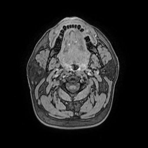 File:Cerebral venous thrombosis with secondary intracranial hypertension (Radiopaedia 89842-106957 Axial T1 C+ 3).jpg