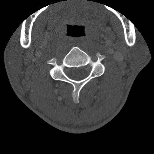 Cervical Pott disease (Radiopaedia 20374-20286 Axial bone window 55).jpg