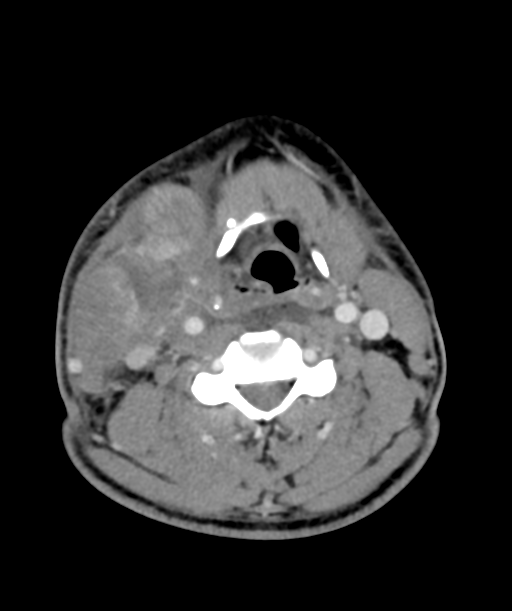 Cervical abscess (Radiopaedia 43725-47184 A 38).png