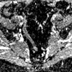 File:Cervical adenocarcinoma (Radiopaedia 65011-73985 Axial ADC 24).jpg