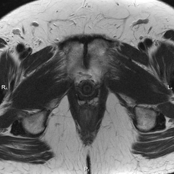 File:Cervical adenocarcinoma (Radiopaedia 65011-73985 Axial T2 9).jpg